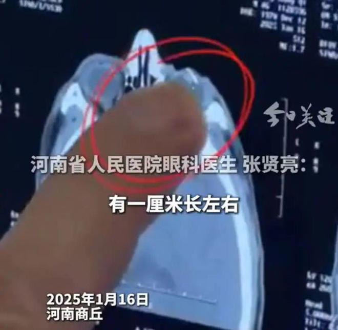 铁锈 钢丝意外飞溅眼中穿透眼角膜凯发一触即发男子拿钢丝球清理门上(图1)